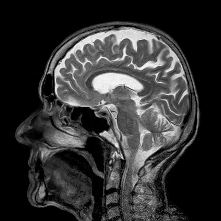 brain scan 
